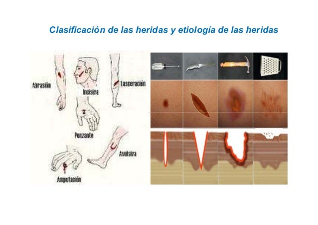 Tipos De Heridas Por Arma De Fuego es.slideshare.net