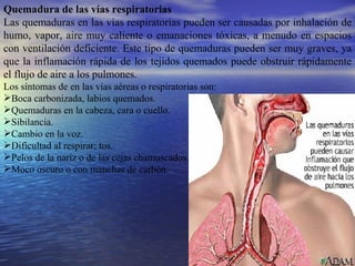 Quemadura de las vías respiratorias Las quemaduras en las vías respiratorias pueden ser causadas por inhalación de humo, vapor, aire muy caliente o emanaciones tóxicas, a menudo en espacios con ventilación deficiente. Este tipo de quemaduras pueden ser muy graves, ya que la inflamación rápida de los tejidos quemados puede obstruir rápidamente el flujo de aire a los pulmones. Los síntomas de en las vías aéreas o respiratorias son: Boca carbonizada, labios quemados. Quemaduras en la cabeza, cara o cuello. Sibilancia. Cambio en la voz. Dificultad al respirar; tos. Pelos de la nariz o de las cejas chamuscados. Moco oscuro o con manchas de carbón. 