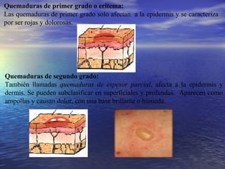 Quemaduras de primer grado o eritema:  Las quemaduras de primer grado solo afectan  a la epidermis y se caracteriza por ser rojas y dolorosas. Quemaduras de segundo grado:   También llamadas  quemaduras de espesor parcial , afecta a la epidermis y dermis. Se pueden subclasificar en superficiales y profundas.  Aparecen como ampollas y causan dolor, con una base brillante o húmeda.   