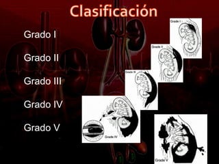 Grado I

Grado II

Grado III

Grado IV

Grado V
 