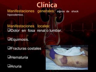 Manifestaciones generales:   signos de shock
hipovolemico.



Manifestaciones locales:
Dolor en fosa renal o lumbar.

Equimosis.

Fracturas costales

Hematuria

Anuria
 