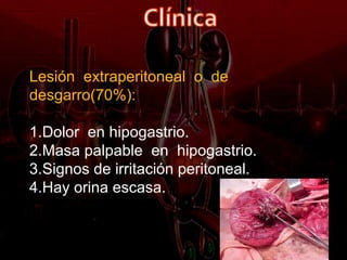 Lesión extraperitoneal o de
desgarro(70%):

1.Dolor en hipogastrio.
2.Masa palpable en hipogastrio.
3.Signos de irritación peritoneal.
4.Hay orina escasa.
 