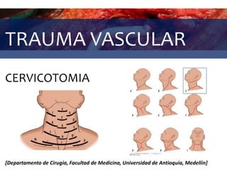 TRAUMA VASCULAR
CERVICOTOMIA
[Departamento de Cirugía, Facultad de Medicina, Universidad de Antioquia, Medellín]
 
