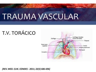 TRAUMA VASCULAR
T.V. TORÁCICO
[REV. MED. CLIN. CONDES - 2011; 22(5) 686-696]
 