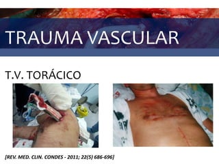 TRAUMA VASCULAR
T.V. TORÁCICO
[REV. MED. CLIN. CONDES - 2011; 22(5) 686-696]
 