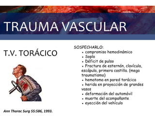 TRAUMA VASCULAR
T.V. TORÁCICO
Ann Thorac Surg 55:586, 1993.
SOSPECHARLO:
● compromiso hemodinámico
● Soplo
● Déficit de pulso
● Fractura de esternón, clavícula,
escápula, primera costilla. (mega
traumatismo)
● hematoma en pared torácica
● herida en proyección de grandes
vasos
● deformación del automóvil
● muerte del acompañante
● eyección del vehículo
 