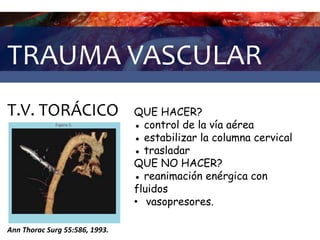 TRAUMA VASCULAR
T.V. TORÁCICO
Ann Thorac Surg 55:586, 1993.
QUE HACER?
● control de la vía aérea
● estabilizar la columna cervical
● trasladar
QUE NO HACER?
● reanimación enérgica con
fluidos
• vasopresores.
 