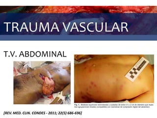 TRAUMA VASCULAR
T.V. ABDOMINAL
[REV. MED. CLIN. CONDES - 2011; 22(5) 686-696]
 