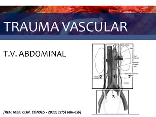 TRAUMA VASCULAR
T.V. ABDOMINAL
[REV. MED. CLIN. CONDES - 2011; 22(5) 686-696]
 