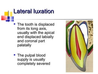 Lateral luxationLateral luxation
 The tooth is displaced
from its long axis,
usually with the apical
end displaced labially
and coronal part
palatally
 The pulpal blood
supply is usually
completely severed
 