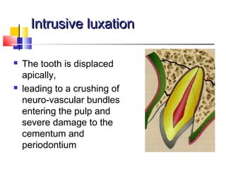 Intrusive luxationIntrusive luxation
 The tooth is displaced
apically,
 leading to a crushing of
neuro-vascular bundles
entering the pulp and
severe damage to the
cementum and
periodontium
 