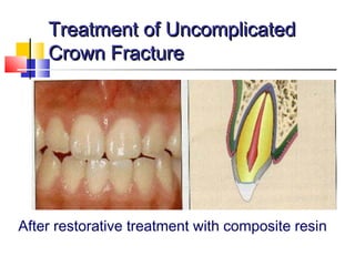 Treatment of UncomplicatedTreatment of Uncomplicated
Crown FractureCrown Fracture
After restorative treatment with composite resin
 