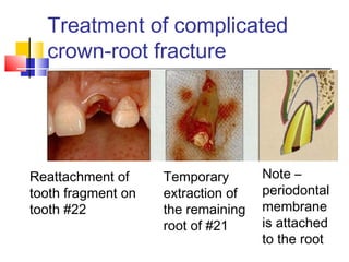 Treatment of complicated
crown-root fracture
Reattachment of
tooth fragment on
tooth #22
Temporary
extraction of
the remaining
root of #21
Note –
periodontal
membrane
is attached
to the root
 
