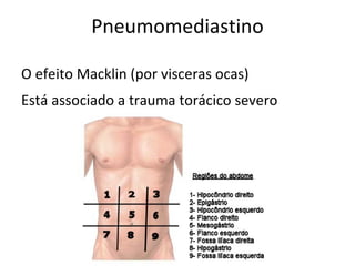 Pneumomediastino

O efeito Macklin (por visceras ocas)
Está associado a trauma torácico severo
 