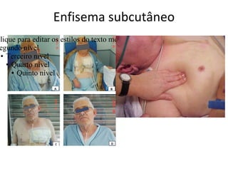 Enfisema subcutâneo
Clique para editar os estilos do texto mestre
 egundo nível
 ● Terceiro nível

   ● Quarto nível

     ● Quinto nível
 