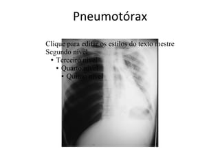 Pneumotórax
Clique para editar os estilos do texto mestre
Segundo nível
 ● Terceiro nível

   ● Quarto nível

     ● Quinto nível
 