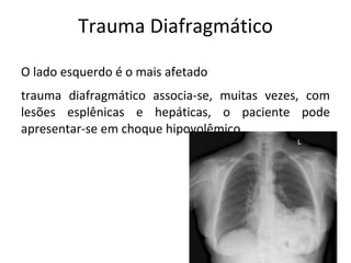 Trauma Diafragmático

O lado esquerdo é o mais afetado
trauma diafragmático associa-se, muitas vezes, com
lesões esplênicas e hepáticas, o paciente pode
apresentar-se em choque hipovolêmico
 