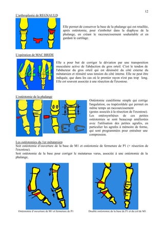 12
L'arthroplastie de REGNAULD
Elle permet de conserver la base de la phalange qui est retaillée,
après ostéotomie, pour s'emboîter dans la diaphyse de la
phalange, en créant le raccourcissement souhaitable et en
gardant le cartilage.
L'opération de MAC BRIDE
Elle a pour but de corriger la déviation par une transposition
musculaire active de l'abduction du gros orteil. C'est le tendon de
l'abducteur du gros orteil qui est désinséré du côté externe du
métatarsien et réinséré sous tension du côté interne. Elle ne peut être
indiquée, que dans les cas où le premier rayon n'est pas trop long.
Elle est souvent associée à une résection de l'exostose.
L'ostéotomie de la phalange
Ostéotomie cunéiforme simple qui corrige
l'angulation, ou trapézoïdale qui permet en
même temps un raccourcissement
(gestes associés à la résection de l'exostose).
Les ostéosynthèses de ces petites
ostéotomies se sont beaucoup améliorées
avec l'utilisation des petites agrafes, en
particulier les agrafes à mémoire de forme,
qui sont programmées pour entraîner une
compression.
Les ostéotomies du 1er métatarsien
Soit ostéotomie d’ouverture de la base de M1 et ostéotomie de fermeture de P1 (+ résection de
l'exostose).
Soit ostéotomie de la base pour corriger le metatarsus varus, associée à une ostéotomie de la
phalange,
Ostéotomie d’ouverture de M1 et fermeture de P1 Double ostéotomie de la base de P1 et du col de M1
 