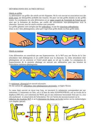 14
DÉFORMATIONS DES AUTRES ORTEILS
Orteils en griffes
La déformation «en griffe» des orteils est très fréquente. On la voit souvent en association avec des
pieds creux, par déséquilibre probable des muscles. On peut voir des griffes distales ou des griffes
totales. La conséquence de cette déformation est un appui exagéré de l'extrémité de l'orteil au sol,
ainsi que la formation de durillons, par conflit des articulations inter-phalangiennes avec la
chaussure. Souvent, tous les orteils externes sont concernés.
Les griffes gênantes sont corrigées par des arthrodèses, ou par des résections arthroplasties.
d'une ou de 2 têtes phalangiennes, selon qu'il s'agit d'une griffe distale ou d'une griffe totale.
Orteils en marteau
Cette déformation est caractérisée par une hyperextension de la M-P avec une flexion de la 1ère
articulation inter phalangienne et un conflit dorsal avec la chaussure. La 2ème articulation inter
phalangienne est en extension et l'orteil prend appui au sol par la pulpe. La conséquence de
hyperextension de la première phalange est souvent une subluxation, puis une luxation de
l'articulation métatarso-phalangienne.
Le traitement chirurgicalest souvent nécessaire.
On fait surtout des arthrodèses inter-phalangiennes proximales, en légère flexion.
La cause étant souvent un rayon trop long, on raccourcit le métatarsien correspondant par une
ostéotomie. L’ostéotomie est faite, soit à la base du méta (GIANNESTRAS), soit au niveau de la
diaphyse (HELAL), soit ostéotomie de WEIL qui est une ostéotomie horizontale fixée par vis, avec
chevauchement et conservation de l'articulation. On voit l'action du raccourcissement sur la
réduction des luxations M-P et sur la diminution de charge sur la tête (action sur les métatarsalgies
voir chapitre spécial).
 