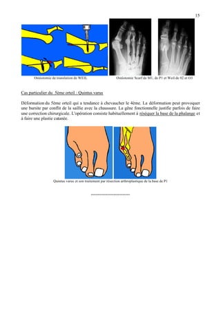 15
Ostéotomie de translation de WEIL Ostéotomie Scarf de M1, de P1 et Weil de 02 et O3
Cas particulier du 5ème orteil : Quintus varus
Déformation du 5ème orteil qui a tendance à chevaucher le 4ème. La déformation peut provoquer
une bursite par conflit de la saillie avec la chaussure. La gêne fonctionnelle justifie parfois de faire
une correction chirurgicale. L'opération consiste habituellement à réséquer la base de la phalange et
à faire une plastie cutanée.
Quintus varus et son traitement par résection arthroplastique de la base de P1
--------------------------
 