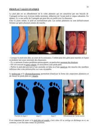 16
PIED PLAT VALGUS STATIQUE
Le pied plat est un effondrement de la voûte plantaire qui est caractérisé par une bascule de
l’astragale en bas avec éversion médio-tarsienne, abduction de l’avant pied et valgus calcanéen. En
dedans, il y a une saillie de l’astragale qui peut être en conflit avec la chaussure.
Chez le jeune enfant, le pied est normalement plat. Les arches plantaires ne sont définitivement
formées qu’après plusieurs années de marche.
- Lorsque le pied reste plat, au cours de la croissance, l’enfant peut être gêné pour marcher et il peur
se produire une usure anormale des chaussures.
- Il y a rarement d’autres problèmes préoccupants, en particulier rarement des douleurs.
- On voit souvent un genu valgum, en association à des pieds plats.
- Parfois le pied plat provient d’une anomalie en talus ou d’une paralysie des muscles des membres
inférieurs due à une poliomyélite ou à une myopathie.
Le podoscope et le photopodogramme permettent d'analyser la forme des empreintes plantaires et
de classer les pieds plats en 3 degrés.
Pied plat de degré 1 degré 2 degré 3 Effondrement de l’arche interne
Il est important de noter si le pied plat est souple, c'est à dire s'il se corrige en décharge ou si, au
contraire, il est fixé dans toutes les positions.
 