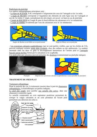 17
Radiologie du pied plat
Les repères radiographiques principaux sont :
- La ligne de SCHADE A-B, correspond à l’alignement des axes de l’astragale et du 1er méta.
- L’angle de MÉARY correspond à l’angulation des éléments de cette ligne (axe de l’astragale et
axe du 1er méta). L’angle, normalement de zéro degré, est ouvert en haut en cas de pied plat.
- L'angle de ROCHER est l’angle R entre le bord inférieur du calcaneum et le 1er métatarsien.
- L’angle de HIBBS est délimité par l’axe du calcaneum avec le 1er métatarsien.
Angles de Rocher et de Hibbs sur un pied normal Angle de Méary sur un pied plat
- Les synostoses calcanéo-scaphoïdiennes (qui ne sont parfois visibles, que sur les clichés de 3/4),
peuvent expliquer certains pieds plats évolutifs, chez des enfants ou des adolescents. La soudure
anormale entre les deux os gêne le développement harmonieux de l’arrière pied et l’astragale
bascule autour du bloc formé par le calcanéum et le scaphoïde.
Ces pieds plats par synostose peuvent présenter des douleurs (contrairement au pied plat statique).
Pied plat Dépister les synostoses calcanéo-scaphoïdiennes (cause possible de pied plat)
TRAITEMENT DU PIED PLAT
Traitement orthopédique
Dans la majorité des cas, le traitement consiste dans le port de chaussures
orthopédiques, la kinésithérapie est parfois indiquée.
Le pied plat souple peut justifier une semelle dite active, dans une
chaussure à contrefort rigide.
La semelle comprendra un coin supinateur postérieur permettant de
corriger le valgus calcanéen et un coin pronateur de l'avant pied
permettant une détorsion de celui-ci.
 