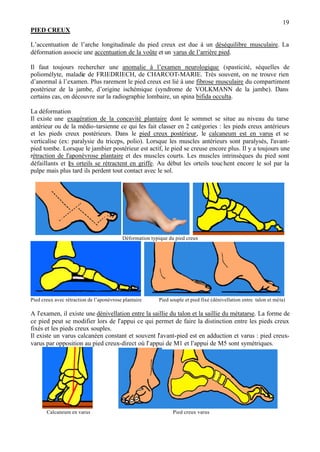 19
PIED CREUX
L’accentuation de l’arche longitudinale du pied creux est due à un déséquilibre musculaire. La
déformation associe une accentuation de la voûte et un varus de l’arrière pied.
Il faut toujours rechercher une anomalie à l’examen neurologique (spasticité, séquelles de
poliomélyte, maladie de FRIEDRIECH, de CHARCOT-MARIE. Très souvent, on ne trouve rien
d’anormal à l’examen. Plus rarement le pied creux est lié à une fibrose musculaire du compartiment
postérieur de la jambe, d’origine ischémique (syndrome de VOLKMANN de la jambe). Dans
certains cas, on découvre sur la radiographie lombaire, un spina bifida occulta.
La déformation
Il existe une exagération de la concavité plantaire dont le sommet se situe au niveau du tarse
antérieur ou de la médio-tarsienne ce qui les fait classer en 2 catégories : les pieds creux antérieurs
et les pieds creux postérieurs. Dans le pied creux postérieur, le calcaneum est en varus et se
verticalise (ex: paralysie du triceps, polio). Lorsque les muscles antérieurs sont paralysés, l'avant-
pied tombe. Lorsque le jambier postérieur est actif, le pied se creuse encore plus. Il y a toujours une
rétraction de l'aponévrose plantaire et des muscles courts. Les muscles intrinsèques du pied sont
défaillants et les orteils se rétractent en griffe. Au début les orteils touchent encore le sol par la
pulpe mais plus tard ils perdent tout contact avec le sol.
Déformation typique du pied creux
Pied creux avec rétraction de l’aponévrose plantaire Pied souple et pied fixé (dénivellation entre talon et méta)
A l’examen, il existe une dénivellation entre la saillie du talon et la saillie du métatarse. La forme de
ce pied peut se modifier lors de l’appui ce qui permet de faire la distinction entre les pieds creux
fixés et les pieds creux souples.
Il existe un varus calcanéen constant et souvent l’avant-pied est en adduction et varus : pied creux-
varus par opposition au pied creux-direct où l’appui de M1 et l’appui de M5 sont symétriques.
Calcaneum en varus Pied creux varus
 