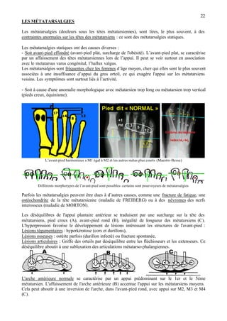 22
LES MÉTATARSALGIES
Les métatarsalgies (douleurs sous les têtes métatarsiennes), sont liées, le plus souvent, à des
contraintes anormales sur les têtes des métatarsiens : ce sont des métatarsalgies statiques.
Les métatarsalgies statiques ont des causes diverses :
- Soit avant-pied effondré (avant-pied plat, surcharge de l'obésité). L’avant-pied plat, se caractérise
par un affaissement des têtes métatarsiennes lors de l’appui. Il peut se voir surtout en association
avec le metatarsus varus congénital, l’hallux valgus.
Les métatarsalgies sont fréquentes chez les femmes d’âge moyen, chez qui elles sont le plus souvent
associées à une insuffisance d’appui du gros orteil, ce qui exagère l'appui sur les métatarsiens
voisins. Les symptômes sont surtout liés à l’activité.
- Soit à cause d'une anomalie morphologique avec métatarsien trop long ou métatarsien trop vertical
(pieds creux, équinisme).
L’avant-pied harmonieux a M1 égal à M2 et les autres métas plus courts (Maestro-Besse)
Différents morphotypes de l’avant-pied sont possibles .certains sont pourvoyeurs de métatarsalgies
Parfois les métatarsalgies peuvent être dues à d’autres causes, comme une fracture de fatigue, une
ostéochondrite de la tête métatarsienne (maladie de FREIBERG) ou à des névromes des nerfs
interosseux (maladie de MORTON).
Les déséquilibres de l'appui plantaire antérieur se traduisent par une surcharge sur la tête des
métatarsiens, pied creux (A), avant-pied rond (B), inégalité de longueur des métatarsiens (C).
L'hyperpression favorise le développement de lésions intéressant les structures de l'avant-pied :
Lésions tégumentaires : hyperkératose (cors et durillons),
Lésions osseuses : ostéite parfois (durillon infecté) ou fracture spontanée,
Lésions articulaires : Griffe des orteils par déséquilibre entre les fléchisseurs et les extenseurs. Ce
déséquilibre aboutit à une subluxation des articulations métatarso-phalangiennes.
L'arche antérieure normale se caractérise par un appui prédominant sur le 1er et le 5ème
métatarsien. L'affaissement de l'arche antérieure (B) accentue l'appui sur les métatarsiens moyens.
Cela peut aboutir à une inversion de l'arche, dans l'avant-pied rond, avec appui sur M2, M3 et M4
(C).
 