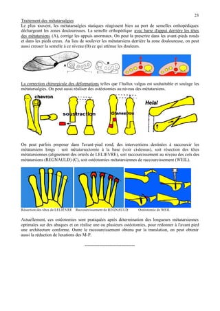 23
Traitement des métatarsalgies
Le plus souvent, les métatarsalgies statiques réagissent bien au port de semelles orthopédiques
déchargeant les zones douloureuses. La semelle orthopédique avec barre d'appui derrière les têtes
des métatarsiens (A), corrige les appuis anormaux. On peut la prescrire dans les avant-pieds ronds
et dans les pieds creux. Au lieu de soulever les métatarsiens derrière la zone douloureuse, on peut
aussi creuser la semelle à ce niveau (B) ce qui atténue les douleurs.
La correction chirurgicale des déformations telles que l’hallux valgus est souhaitable et soulage les
métatarsalgies. On peut aussi réaliser des ostéotomies au niveau des métatarsiens.
On peut parfois proposer dans l'avant-pied rond, des interventions destinées à raccourcir les
métatarsiens longs : soit métatarsectomie à la base (voir ci-dessus), soit résection des têtes
métatarsiennes (alignement des orteils de LELIEVRE), soit raccourcissement au niveau des cols des
métatarsiens (REGNAULD) (C), soit ostéotomies métatarsiennes de raccourcissement (WEIL).
Résection des têtes de LELIÈVRE Raccourcissement de REGNAULD Ostéotomie de WEIL
Actuellement, ces ostéotomies sont pratiquées après détermination des longueurs métatarsiennes
optimales sur des abaques et on réalise une ou plusieurs ostéotomies, pour redonner à l'avant pied
une architecture conforme. Outre le raccourcissement obtenu par la translation, on peut obtenir
aussi la réduction de luxations des M-P.
----------------------------------
 