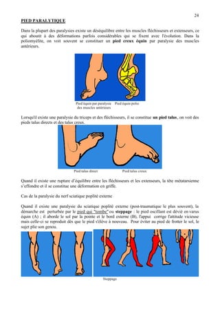 24
PIED PARALYTIQUE
Dans la plupart des paralysies existe un déséquilibre entre les muscles fléchisseurs et extenseurs, ce
qui aboutit à des déformations parfois considérables qui se fixent avec l'évolution. Dans la
poliomyélite, on voit souvent se constituer un pied creux équin par paralysie des muscles
antérieurs.
Pied équin par paralysie Pied équin polio
des muscles antérieurs
Lorsqu'il existe une paralysie du triceps et des fléchisseurs, il se constitue un pied talus, on voit des
pieds talus directs et des talus creux.
Pied talus direct Pied talus creux
Quand il existe une rupture d’équilibre entre les fléchisseurs et les extenseurs, la tête métatarsienne
s’effondre et il se constitue une déformation en griffe.
Cas de la paralysie du nerf sciatique poplité externe
Quand il existe une paralysie du sciatique poplité externe (post-traumatique le plus souvent), la
démarche est perturbée par le pied qui "tombe" ou steppage : le pied oscillant est dévié en varus
équin (A) ; il aborde le sol par la pointe et le bord externe (B), l'appui corrige l'attitude vicieuse
mais celle-ci se reproduit dès que le pied s'élève à nouveau. Pour éviter au pied de frotter le sol, le
sujet plie son genou.
Steppage
 