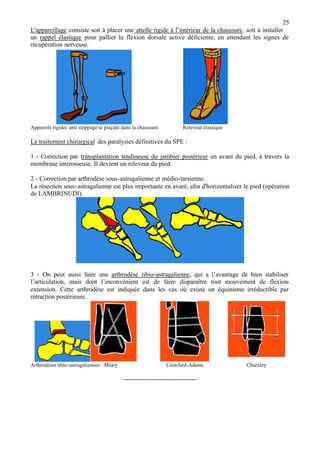 25
L'appareillage consiste soit à placer une attelle rigide à l’intérieur de la chaussure, soit à installer
un rappel élastique pour pallier la flexion dorsale active déficiente, en attendant les signes de
récupération nerveuse.
Appareils rigides anti steppage se plaçant dans la chaussure Releveur élastique
Le traitement chirurgical des paralysies définitives du SPE :
1 - Correction par transplantation tendineuse du jambier postérieur en avant du pied, à travers la
membrane interosseuse. Il devient un releveur du pied.
2 - Correction par arthrodèse sous-astragalienne et médio-tarsienne.
La résection sous-astragalienne est plus importante en avant, afin d'horizontaliser le pied (opération
de LAMBRINUDI).
3 - On peut aussi faire une arthrodèse tibio-astragalienne, qui a l’avantage de bien stabiliser
l’articulation, mais dont l’inconvénient est de faire disparaître tout mouvement de flexion-
extension. Cette arthrodèse est indiquée dans les cas où existe un équinisme irréductible par
rétraction postérieure.
Arthrodèses tibio-astragaliennes : Méary Crawford-Adams Charnley
----------------------------------
 