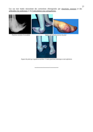27
Les cas non traités nécessitent des corrections chirurgicales par résections osseuses et des
arthrodèse du médiotarse et de l’articulation sous astragalienne.
Pied bot invétéré d’un adulte Appui sur le bord externe du pied
Aspect du pied qui regarde en arrière. L’autre pied était identique avant opération
--------------------------------------
 