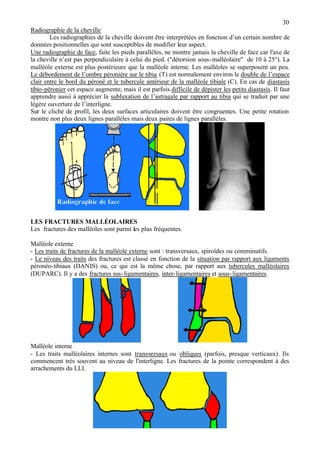 30
Radiographie de la cheville
Les radiographies de la cheville doivent être interprétées en fonction d’un certain nombre de
données positionnelles qui sont susceptibles de modifier leur aspect.
Une radiographie de face, faite les pieds parallèles, ne montre jamais la cheville de face car l'axe de
la cheville n’est pas perpendiculaire à celui du pied. ("détorsion sous-malléolaire" de 10 à 25°). La
malléole externe est plus postérieure que la malléole interne. Les malléoles se superposent un peu.
Le débordement de l’ombre péronière sur le tibia (T) est normalement environ le double de l’espace
clair entre le bord du péroné et le tubercule antérieur de la malléole tibiale (C). En cas de diastasis
tibio-péronier cet espace augmente, mais il est parfois difficile de dépister les petits diastasis. Il faut
apprendre aussi à apprécier la subluxation de l’astragale par rapport au tibia qui se traduit par une
légère ouverture de l’interligne.
Sur le cliché de profil, les deux surfaces articulaires doivent être congruentes. Une petite rotation
montre non plus deux lignes parallèles mais deux paires de lignes parallèles.
LES FRACTURES MALLÉOLAIRES
Les fractures des malléoles sont parmi les plus fréquentes.
Malléole externe
- Les traits de fractures de la malléole externe sont : transversaux, spiroïdes ou comminutifs.
- Le niveau des traits des fractures est classé en fonction de la situation par rapport aux ligaments
péronéo-tibiaux (DANIS) ou, ce qui est la même chose, par rapport aux tubercules malléolaires
(DUPARC). Il y a des fractures sus-ligamentaires, inter-ligamentaires et sous-ligamentaires.
Malléole interne
- Les traits malléolaires internes sont transversaux ou obliques (parfois, presque verticaux). Ils
commencent très souvent au niveau de l'interligne. Les fractures de la pointe correspondent à des
arrachements du LLI.
 