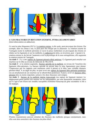 33
Fracture de Maisonneuve. Fracture possible de la malléole postérieure (DESTOT)
4 / LES FRACTURES EN ROTATION EXTERNE, INTRA-LIGAMENTAIRES
(Inter-tuberculaires en adduction).
Ce sont les plus fréquentes (50 %). La rotation externe, à elle seule, peut provoquer des lésions. Par
exemple, dans les chutes à ski, le pied peut être bloqué par la chaussure. La rotation externe de
l’astragale écarte la malléole péronière et ouvre la pince malléolaire en provoquant des lésions en
chaîne sur les ligaments et sur les malléoles. L’adductiondu talon, ou inversion, peut s’ajouter à la
rotation externe et, du fait de l’anatomie et de la physiologie de la sous-astragalienne, elle augmente
la rotation externe de l’astragale.
Au stade 1 : il y a une rupture du ligament péronéo-tibial antérieur. Ce ligament peut arracher son
insertion sur le tibia au niveau du tubercule de TILLAUX.
Au stade 2 : si la rotation augmente, fracture spiroïde de la malléole au niveau de l’insertion des
ligaments tibio-péroniers. La fracture spiroïde du péroné dans la zone ligamentaire peut donner
l’impression que les rapports sont maintenus entre le péroné et le tibia, sans véritable diastasis
péronéo-tibial. A un degré de plus, on peut avoir une rupture du ligament tibio-périonier postérieur
(ou un arrachement de son insertion sur le rebord tibial postérieur). Il peut y avoir un diastasis tibio-
péronier plus ou moins important, surtout si les deux faisceaux sont rompus.
Au stade 3 : fracture de la malléole interne transversale (ou rupture du ligament interne). Le
déplacement parait parfois très minime sur les radiographies, qui sont faussement rassurantes, alors
qu’il s’agit d’une lésion très instable susceptible d'entraîner beaucoup de gêne secondaire si elle a
été négligée.
Stade 1 Stade 2 Stade 3
D'autres traumatismes peuvent entraîner des fractures des malléoles presque constamment, mais
elles sont alors associées à des fractures du pilon tibial :
 