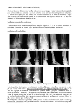 37
Les fractures déplacées et instables d’une malléole
L'ostéosynthèse se faite soit par broche, soit par vis ou par plaque vissée. L’immobilisation plâtrée
peut se limiter à 2 ou 3 semaines seulement selon les cas et la rééducation est rapidement entreprise.
La marche avec appui peut être reprise vers la 6ème semaine avec un plâtre de marche et l’appui
libre envisagé, en fonction de la qualité de la consolidation radiologique, entre la 8ème
et la 10ème
semaine. La rééducation est alors entreprise.
Les fractures marginales postérieures
L'ostéosynthèse de la fracture marginale est indiquée si plus de 25 % de la surface articulaire est
concernée. On réalise un vissage direct par l'arrière ou un vissage en rappel par l’avant.
Les fractures bi malléolaires
Fracture très déplacée opérée à l’âge de 51 ans Résultat correct sans arthrose 10 ans plus tard
Fracture de la malléole postérieure de Destot (blessé de 77 ans) Exemple d’une vis de « syndesmodèse temporaire »
L’ostéosynthèse des fractures bi-malléolaires ou tri malléolaires est réalisée par des vis ou des
plaques vissées sur le péroné. Le diastasis disparaît dès que le péroné est parfaitement réduit. Il ne
faut pas négliger la réparation ligamentaire du ligament interne (qui peut s’interposer entre la
malléole interne et l’astragale). Les ligaments tibio-péroniers sont réparés après rétablissement de la
forme du péroné et réduction parfaite de la péronéo-tibiale inférieure. Leur suture est assez délicate
en général, l’ostéosynthèse des fragments osseux arrachés avec les ligaments péronéo-tibiaux est
plus facile à réaliser (par broche ou vis).
On peut parfois solidariser le péroné et le tibia par une vis transversale provisoire. Cette vis, mise au
dessus de la syndesmose tibio-péronière est dite "vis de syndesmodèse". Elle est laissée jusqu’à la
 