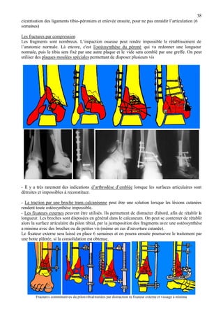 38
cicatrisation des ligaments tibio-péroniers et enlevée ensuite, pour ne pas enraidir l’articulation (6
semaines)
Les fractures par compression
Les fragments sont nombreux. L’impaction osseuse peut rendre impossible le rétablissement de
l’anatomie normale. Là encore, c'est l'ostéosynthèse du péroné qui va redonner une longueur
normale, puis le tibia sera fixé par une autre plaque et le vide sera comblé par une greffe. On peut
utiliser des plaques moulées spéciales permettant de disposer plusieurs vis
- Il y a très rarement des indications d’arthrodèse d’emblée lorsque les surfaces articulaires sont
détruites et impossibles à reconstituer.
- La traction par une broche trans-calcanéenne peut être une solution lorsque les lésions cutanées
rendent toute ostéosynthèse impossible.
- Les fixateurs externes peuvent être utilisés. Ils permettent de distracter d'abord, afin de rétablir la
longueur. Les broches sont disposées en général dans le calcaneum. On peut se contenter de rétablir
alors la surface articulaire du pilon tibial, par la juxtaposition des fragments avec une ostéosynthèse
a minima avec des broches ou de petites vis (même en cas d'ouverture cutanée).
Le fixateur externe sera laissé en place 6 semaines et on pourra ensuite poursuivre le traitement par
une botte plâtrée, si la consolidation est obtenue.
Fractures comminutives du pilon tibialtraitées par distraction ra fixateur externe et vissage à minima
 