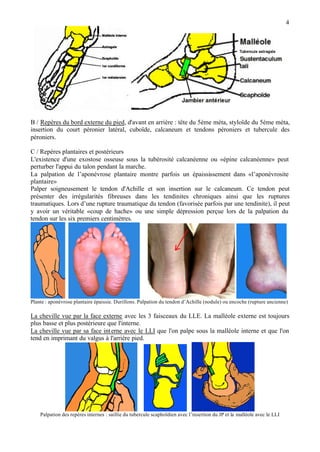 4
B / Repères du bord externe du pied, d'avant en arrière : tête du 5ème méta, styloïde du 5ème méta,
insertion du court péronier latéral, cuboïde, calcaneum et tendons péroniers et tubercule des
péroniers.
C / Repères plantaires et postérieurs
L'existence d'une exostose osseuse sous la tubérosité calcanéenne ou «épine calcanéenne» peut
perturber l'appui du talon pendant la marche.
La palpation de l’aponévrose plantaire montre parfois un épaississement dans «l’aponévrosite
plantaire»
Palper soigneusement le tendon d'Achille et son insertion sur le calcaneum. Ce tendon peut
présenter des irrégularités fibreuses dans les tendinites chroniques ainsi que les ruptures
traumatiques. Lors d’une rupture traumatique du tendon (favorisée parfois par une tendinite), il peut
y avoir un véritable «coup de hache» ou une simple dépression perçue lors de la palpation du
tendon sur les six premiers centimètres.
Plante : aponévrose plantaire épaissie. Durillons. Palpation du tendon d’Achille (nodule) ou encoche (rupture ancienne)
La cheville vue par la face externe avec les 3 faisceaux du LLE. La malléole externe est toujours
plus basse et plus postérieure que l'interne.
La cheville vue par sa face interne avec le LLI que l'on palpe sous la malléole interne et que l'on
tend en imprimant du valgus à l'arrière pied.
Palpation des repères internes : saillie du tubercule scaphoïdien avec l’insertion du JP et la malléole avec le LLI
 