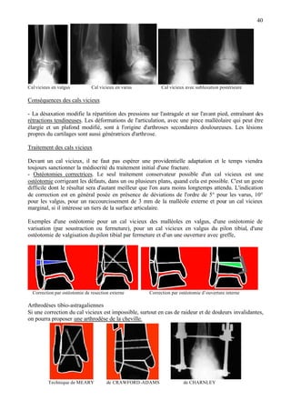 40
Calvicieux en valgus Cal vicieux en varus Cal vicieux avec subluxation postérieure
Conséquences des cals vicieux
- La désaxation modifie la répartition des pressions sur l'astragale et sur l'avant pied, entraînant des
rétractions tendineuses. Les déformations de l'articulation, avec une pince malléolaire qui peut être
élargie et un plafond modifié, sont à l'origine d'arthroses secondaires douloureuses. Les lésions
propres du cartilages sont aussi génératrices d'arthrose.
Traitement des cals vicieux
Devant un cal vicieux, il ne faut pas espérer une providentielle adaptation et le temps viendra
toujours sanctionner la médiocrité du traitement initial d'une fracture.
- Ostéotomies correctrices. Le seul traitement conservateur possible d'un cal vicieux est une
ostéotomie corrigeant les défauts, dans un ou plusieurs plans, quand cela est possible. C'est un geste
difficile dont le résultat sera d'autant meilleur que l'on aura moins longtemps attendu. L'indication
de correction est en général posée en présence de déviations de l'ordre de 5° pour les varus, 10°
pour les valgus, pour un raccourcissement de 3 mm de la malléole externe et pour un cal vicieux
marginal, si il intéresse un tiers de la surface articulaire.
Exemples d'une ostéotomie pour un cal vicieux des malléoles en valgus, d'une ostéotomie de
varisation (par soustraction ou fermeture), pour un cal vicieux en valgus du pilon tibial, d'une
ostéotomie de valgisation dupilon tibial par fermeture et d'un une ouverture avec greffe,
Correction par ostéotomie de resection externe Correction par ostéotomie d’ouverture interne
Arthrodèses tibio-astragaliennes
Si une correction du cal vicieux est impossible, surtout en cas de raideur et de douleurs invalidantes,
on pourra proposer une arthrodèse de la cheville.
Technique de MEARY de CRAWFORD-ADAMS de CHARNLEY
 