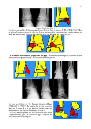42
Fracture-décollement Salter 3
Une forme particulière de fracture-décollement de type 3 est la fracture de TILLAUX-CHAPUT où
le tubercule antéro-externe du tibia est détaché au cours d'un mouvement de rotation externe du
pied, par la traction du ligament tibio-péronier inférieur. Fixation par vis ou broches.
Les fractures-décollements épiphysaires de type 4 traversent le cartilage de croissance et sont
pourvoyeuses d'épiphysiodèse. Leur réduction doit être parfaite.
Un cas particulier est la fracture triplane oblique
(TILLAUX et FROST). Le trait de fracture est complexe
dans les 3 plans. Il y a un fragment métaphysaire, un
décollement et une fracture épiphysaire de type 3.
La lecture radiographique est difficile car on peut avoir
l'impression d'un type 3 de face et d'un type 2 de profil. La
réduction doit être chirurgicale.
 