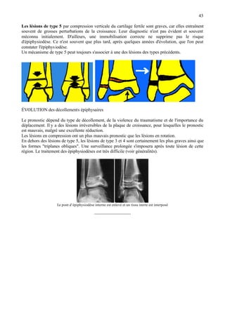 43
Les lésions de type 5 par compression verticale du cartilage fertile sont graves, car elles entraînent
souvent de grosses perturbations de la croissance. Leur diagnostic n'est pas évident et souvent
méconnu initialement. D'ailleurs, une immobilisation correcte ne supprime pas le risque
d'épiphysiodèse. Ce n'est souvent que plus tard, après quelques années d'évolution, que l'on peut
constater l'épiphysiodèse.
Un mécanisme de type 5 peut toujours s'associer à une des lésions des types précédents.
ÉVOLUTION des décollements épiphysaires
Le pronostic dépend du type de décollement, de la violence du traumatisme et de l'importance du
déplacement. Il y a des lésions irréversibles de la plaque de croissance, pour lesquelles le pronostic
est mauvais, malgré une excellente réduction.
Les lésions en compression ont un plus mauvais pronostic que les lésions en rotation.
En dehors des lésions de type 5, les lésions de type 3 et 4 sont certainement les plus graves ainsi que
les formes "triplanes obliques". Une surveillance prolongée s'imposera après toute lésion de cette
région. Le traitement des épiphysiodèses est très difficile (voir généralités).
Le pont d’épiphysiodèse interne est enlevé et un tissu inerte est interposé
-----------------------------
 