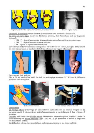 46
Fragment ostéochondral supéro-externe enplace ,basculé ou retourné Fracture supéro interne
Les clichés dynamiques peuvent être faits éventuellement sous anesthésie, si nécessaire.
Le cliché en varus équin montre un bâillement anormal, dont l'importance aide au diagnostic
lésionnel :
- 10 à 15° : signent la rupture du faisceau péronéo-astragalien antérieur, premier rompu.
- 20 à 25° : signent la rupture de deux faisceaux.
- 30° : signent la rupture des trois faisceaux.
Le bâillement de l'articulation sous-astragalienne est visible sur ces clichés, mais plus difficilement.
On peut mesurer aussi, la translation latérale du calcaneum par rapport à l'astragale.
La mesure du tiroir antérieur
Elle se fait sur un cliché de profil. Le tiroir est pathologique au dessus de 7 à 8 mm de bâillement
postérieur tibio-astragalien.
Radio en tiroir manuel Tiroir antérieur fait avec un poids
Le traitement
Le bandage adhésif (strapping), est une contention suffisante dans les entorses bénignes ou de
moyenne gravité. Il est associé aux anti-inflammatoires et à la physiothérapie. Il dure 15 jours à 3
semaines.
Le plâtre, sous forme d'une botte de marche, immobilisera les entorses graves, pendant 45 jours. On
utilise beaucoup les attelles amovibles (type "AIRCAST"), qui permettent la marche et empêchent
les mouvements latéraux.
La rééducation est une étape essentielle du traitement, pour retrouver une bonne stabilité.
 