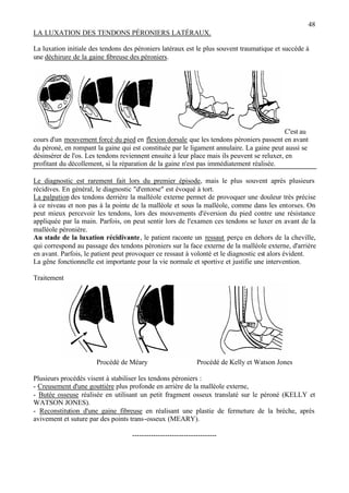 48
LA LUXATION DES TENDONS PÉRONIERS LATÉRAUX.
La luxation initiale des tendons des péroniers latéraux est le plus souvent traumatique et succède à
une déchirure de la gaine fibreuse des péroniers.
C'est au
cours d'un mouvement forcé du pied en flexion dorsale que les tendons péroniers passent en avant
du péroné, en rompant la gaine qui est constituée par le ligament annulaire. La gaine peut aussi se
désinsérer de l'os. Les tendons reviennent ensuite à leur place mais ils peuvent se reluxer, en
profitant du décollement, si la réparation de la gaine n'est pas immédiatement réalisée.
Le diagnostic est rarement fait lors du premier épisode, mais le plus souvent après plusieurs
récidives. En général, le diagnostic "d'entorse" est évoqué à tort.
La palpation des tendons derrière la malléole externe permet de provoquer une douleur très précise
à ce niveau et non pas à la pointe de la malléole et sous la malléole, comme dans les entorses. On
peut mieux percevoir les tendons, lors des mouvements d'éversion du pied contre une résistance
appliquée par la main. Parfois, on peut sentir lors de l'examen ces tendons se luxer en avant de la
malléole péronière.
Au stade de la luxation récidivante, le patient raconte un ressaut perçu en dehors de la cheville,
qui correspond au passage des tendons péroniers sur la face externe de la malléole externe, d'arrière
en avant. Parfois, le patient peut provoquer ce ressaut à volonté et le diagnostic est alors évident.
La gêne fonctionnelle est importante pour la vie normale et sportive et justifie une intervention.
Traitement
Procédé de Méary Procédé de Kelly et Watson Jones
Plusieurs procédés visent à stabiliser les tendons péroniers :
- Creusement d'une gouttière plus profonde en arrière de la malléole externe,
- Butée osseuse réalisée en utilisant un petit fragment osseux translaté sur le péroné (KELLY et
WATSON JONES).
- Reconstitution d'une gaine fibreuse en réalisant une plastie de fermeture de la brèche, après
avivement et suture par des points trans-osseux (MEARY).
------------------------------------
 