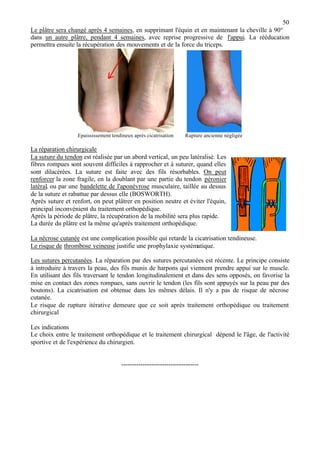 50
Le plâtre sera changé après 4 semaines, en supprimant l'équin et en maintenant la cheville à 90°
dans un autre plâtre, pendant 4 semaines, avec reprise progressive de l'appui. La rééducation
permettra ensuite la récupération des mouvements et de la force du triceps.
Epaississement tendineux après cicatrisation Rupture ancienne négligée
La réparation chirurgicale
La suture du tendon est réalisée par un abord vertical, un peu latéralisé. Les
fibres rompues sont souvent difficiles à rapprocher et à suturer, quand elles
sont dilacérées. La suture est faite avec des fils résorbables. On peut
renforcer la zone fragile, en la doublant par une partie du tendon péronier
latéral, ou par une bandelette de l'aponévrose musculaire, taillée au dessus
de la suture et rabattue par dessus elle (BOSWORTH).
Après suture et renfort, on peut plâtrer en position neutre et éviter l'équin,
principal inconvénient du traitement orthopédique.
Après la période de plâtre, la récupération de la mobilité sera plus rapide.
La durée du plâtre est la même qu'après traitement orthopédique.
La nécrose cutanée est une complication possible qui retarde la cicatrisation tendineuse.
Le risque de thrombose veineuse justifie une prophylaxie systématique.
Les sutures percutanées. La réparation par des sutures percutanées est récente. Le principe consiste
à introduire à travers la peau, des fils munis de harpons qui viennent prendre appui sur le muscle.
En utilisant des fils traversant le tendon longitudinalement et dans des sens opposés, on favorise la
mise en contact des zones rompues, sans ouvrir le tendon (les fils sont appuyés sur la peau par des
boutons). La cicatrisation est obtenue dans les mêmes délais. Il n'y a pas de risque de nécrose
cutanée.
Le risque de rupture itérative demeure que ce soit après traitement orthopédique ou traitement
chirurgical
Les indications
Le choix entre le traitement orthopédique et le traitement chirurgical dépend le l'âge, de l'activité
sportive et de l'expérience du chirurgien.
------------------------------------
 