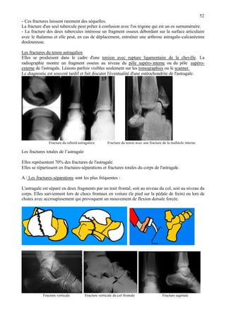 52
- Ces fractures laissent rarement des séquelles.
La fracture d'un seul tubercule peut prêter à confusion avec l'os trigone qui est un os surnuméraire.
- La fracture des deux tubercules intéresse un fragment osseux débordant sur la surface articulaire
avec le thalamus et elle peut, en cas de déplacement, entraîner une arthrose astragalo-calcanéenne
douloureuse.
Les fractures du tenon astragalien
Elles se produisent dans le cadre d'une torsion avec rupture ligamentaire de la cheville. La
radiographie montre un fragment osseux au niveau du pôle supéro-interne ou du pôle supéro-
externe de l'astragale. Lésions parfois visibles seulement sur les tomographies ou le scanner.
Le diagnostic est souvent tardif et fait discuter l'éventualité d'une ostéochondrite de l'astragale.
Fracture du rebord astragalien Fracture du tenon avec une fracture de la malléole interne
Les fractures totales de l’astragale
Elles représentent 70% des fractures de l'astragale.
Elles se répartissent en fractures-séparations et fractures totales du corps de l'astragale.
A / Les fractures-séparations sont les plus fréquentes :
L'astragale est séparé en deux fragments par un trait frontal, soit au niveau du col, soit au niveau du
corps. Elles surviennent lors de chocs frontaux en voiture (le pied sur la pédale de frein) ou lors de
chutes avec accroupissement qui provoquent un mouvement de flexion dorsale forcée.
Fracture verticale Fracture verticale du col frontale Fracture sagittale
 