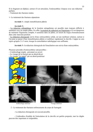55
Si le fragment est déplacé, surtout s'il est articulaire, l'ostéosynthèse s'impose avec une réduction
parfaire.
- Traitement des fractures totales
1- Le traitement des fractures séparations
Au stade 1 : simple immobilisation plâtrée
Au stade 2 :
- La réduction orthopédique de la luxation astragalienne est possible mais toujours difficile à
maintenir avec un simple plâtre. En effet, la position de réduction est l'équinisme et il est dangereux
de maintenir l'équinisme complet, 6 semaines dans un plâtre, en raison du risque d'enraidissement
dans cette mauvaise position.
- La réduction chirurgicale suivie d'une ostéosynthèse solide, est une meilleure solution, surtout si
l'on peut se passer d'une immobilisation plâtrée et mobiliser rapidement la cheville. L'appui ne sera
repris qu'après 2 à 3 mois, lorsque la consolidation radiologique sera suffisante.
Au stade 3 : la réduction chirurgicale de l'énucléation sera suivie d'une ostéosynthèse.
Plusieurs procédés d'ostéosynthèse sont possibles :
- L'embrochage simple, percutané ou ouvert
- Le vissage de la fracture par un abord direct
- Le vissage "en rappel" par un abord postérieur
Vissage antérieur ou postérieur Bonne consolidation après un vissage postérieur
Embrochage antérieur Vissage antérieur
2 - Le traitement des fractures-enfoncements du corps de l'astragale
- La réduction chirurgicale est souvent possible.
- L'arthrodèse d'emblée de l'articulation de la cheville est parfois proposée, tant les dégâts
peuvent être importants et irréparables.
 