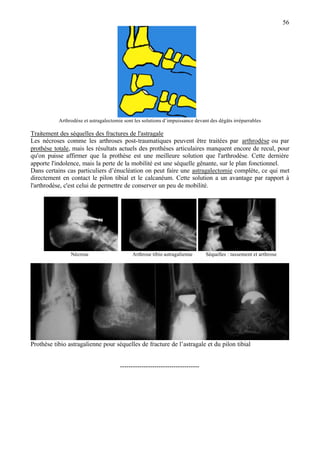 56
Arthrodèse et astragalectomie sont les solutions d’impuissance devant des dégâts irréparrables
Traitement des séquelles des fractures de l'astragale
Les nécroses comme les arthroses post-traumatiques peuvent être traitées par arthrodèse ou par
prothèse totale, mais les résultats actuels des prothèses articulaires manquent encore de recul, pour
qu'on puisse affirmer que la prothèse est une meilleure solution que l'arthrodèse. Cette dernière
apporte l'indolence, mais la perte de la mobilité est une séquelle gênante, sur le plan fonctionnel.
Dans certains cas particuliers d’énucléation on peut faire une astragalectomie complète, ce qui met
directement en contact le pilon tibial et le calcanéum. Cette solution a un avantage par rapport à
l'arthrodèse, c'est celui de permettre de conserver un peu de mobilité.
Nécrose Arthrose tibio astragalienne Séquelles : tassement et arthrose
Prothèse tibio astragalienne pour séquelles de fracture de l’astragale et du pilon tibial
-------------------------------------
 