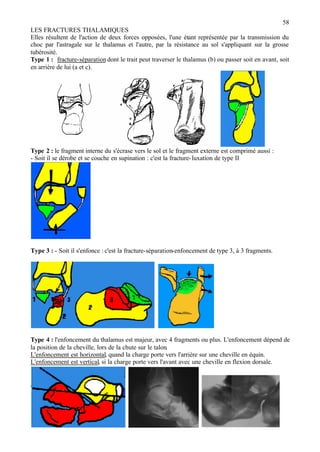 58
LES FRACTURES THALAMIQUES
Elles résultent de l'action de deux forces opposées, l'une étant représentée par la transmission du
choc par l'astragale sur le thalamus et l'autre, par la résistance au sol s'appliquant sur la grosse
tubérosité.
Type 1 : fracture-séparation dont le trait peut traverser le thalamus (b) ou passer soit en avant, soit
en arrière de lui (a et c).
Type 2 : le fragment interne du s'écrase vers le sol et le fragment externe est comprimé aussi :
- Soit il se dérobe et se couche en supination : c'est la fracture-luxation de type II
Type 3 : - Soit il s'enfonce : c'est la fracture-séparation-enfoncement de type 3, à 3 fragments.
Type 4 : l'enfoncement du thalamus est majeur, avec 4 fragments ou plus. L'enfoncement dépend de
la position de la cheville, lors de la chute sur le talon.
L'enfoncement est horizontal, quand la charge porte vers l'arrière sur une cheville en équin.
L'enfoncement est vertical, si la charge porte vers l'avant avec une cheville en flexion dorsale.
 