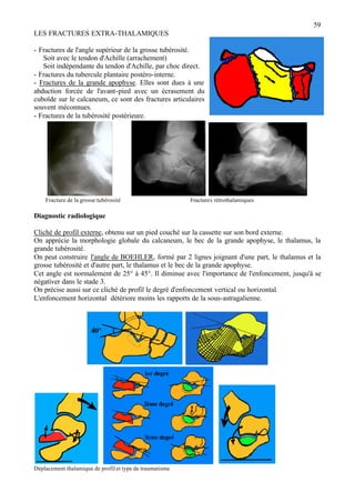 59
LES FRACTURES EXTRA-THALAMIQUES
- Fractures de l'angle supérieur de la grosse tubérosité.
Soit avec le tendon d'Achille (arrachement)
Soit indépendante du tendon d'Achille, par choc direct.
- Fractures du tubercule plantaire postéro-interne.
- Fractures de la grande apophyse. Elles sont dues à une
abduction forcée de l'avant-pied avec un écrasement du
cuboïde sur le calcaneum, ce sont des fractures articulaires
souvent méconnues.
- Fractures de la tubérosité postérieure.
Fracture de la grosse tubérosité Fractures rétrothalamiques
Diagnostic radiologique
Cliché de profil externe, obtenu sur un pied couché sur la cassette sur son bord externe.
On apprécie la morphologie globale du calcaneum, le bec de la grande apophyse, le thalamus, la
grande tubérosité.
On peut construire l'angle de BOEHLER, formé par 2 lignes joignant d'une part, le thalamus et la
grosse tubérosité et d'autre part, le thalamus et le bec de la grande apophyse.
Cet angle est normalement de 25° à 45°. Il diminue avec l'importance de l'enfoncement, jusqu'à se
négativer dans le stade 3.
On précise aussi sur ce cliché de profil le degré d'enfoncement vertical ou horizontal.
L'enfoncement horizontal détériore moins les rapports de la sous-astragalienne.
Déplacement thalamique de profil et type de traumatisme
 