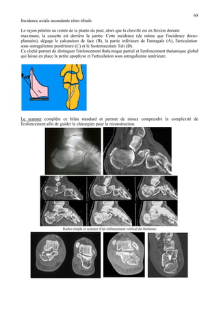 60
Incidence axiale ascendante rétro-tibiale
Le rayon pénètre au centre de la plante du pied, alors que la cheville est en flexion dorsale
maximum, la cassette est derrière la jambe. Cette incidence (de même que l'incidence dorso-
plantaire), dégage le calcanéum de face (B), la partie inférieure de l'astragale (A), l'articulation
sous-astragalienne postérieure (C) et le Sustentaculum Tali (D).
Ce cliché permet de distinguer l'enfoncement thalamique partiel et l'enfoncement thalamique global
qui laisse en place la petite apophyse et l'articulation sous astragalienne antérieure.
Le scanner complète ce bilan standard et permet de mieux comprendre la complexité de
l'enfoncement afin de guider le chirurgien pour la reconstruction.
Radio simple et scanner d’un enfoncement vertical du thalamus
 