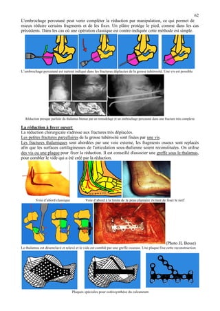 62
L'embrochage percutané peut venir compléter la réduction par manipulation, ce qui permet de
mieux réduire certains fragments et de les fixer. Un plâtre protège le pied, comme dans les cas
précédents. Dans les cas où une opération classique est contre-indiquée cette méthode est simple.
L’embrochage percutané est surtout indiqué dans les fractures déplacées de la grosse tubérosité. Une vis est possible
Réduction presque parfaite du thalamus btenue par un remodelage et un embrochage percutané dans une fracture très complexe
La réduction à foyer ouvert
La réduction chirurgicale s'adresse aux fractures très déplacées.
Les petites fractures parcellaires de la grosse tubérosité sont fixées par une vis.
Les fractures thalamiques sont abordées par une voie externe, les fragments osseux sont replacés
afin que les surfaces cartilagineuses de l'articulation sous-thalienne soient reconstituées. On utilise
des vis ou une plaque pour fixer la réduction. Il est conseillé d'associer une greffe sous le thalamus,
pour combler le vide qui a été créé par la réduction.
Voie d’abord classique Voie d’abord à la limite de la peau plantaire évitant de léser le nerf
(Photo JL Besse)
Le thalamus est désenclavé et relevé et le vide est comblé par une greffe osseuse. Une plaque fixe cette reconstruction
Plaques spéciales pour ostéosynthèse du calcaneum
 